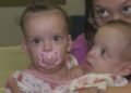 Siamesas de São Paulo passam por nova cirurgia em Goiás durante preparação para serem separadas Siamesas de São Paulo passam por nova cirurgia em Goiás durante preparação para serem separadas