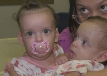 Siamesas de São Paulo passam por nova cirurgia em Goiás durante preparação para serem separadas Siamesas de São Paulo passam por nova cirurgia em Goiás durante preparação para serem separadas