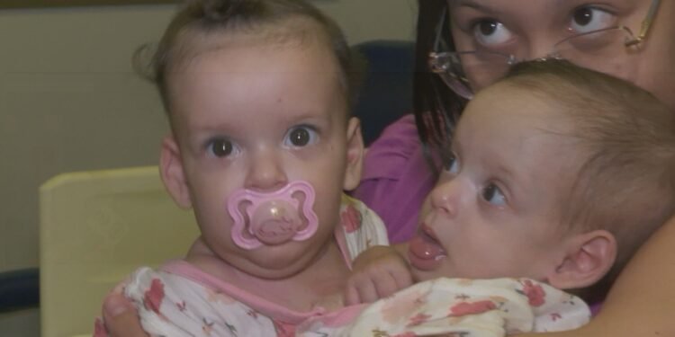 Siamesas de São Paulo passam por nova cirurgia em Goiás durante preparação para serem separadas